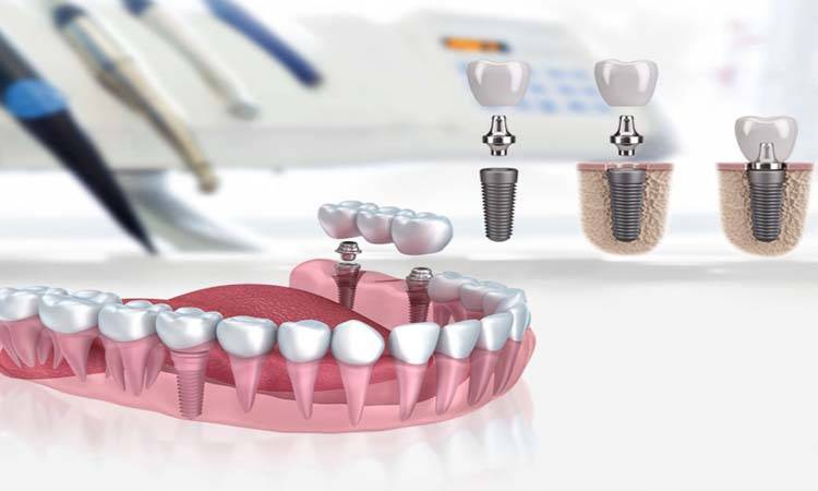 FMDC Arranges Symposium on Dental Implantology