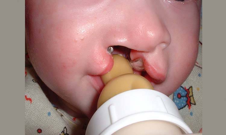 Craniofacial And Cleft Anomalies: Essential Insights