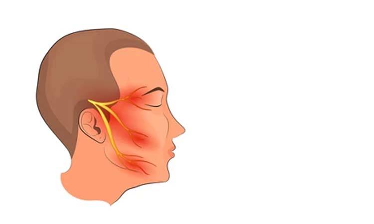 Detecting Trigeminal neuralgia in the dental setting