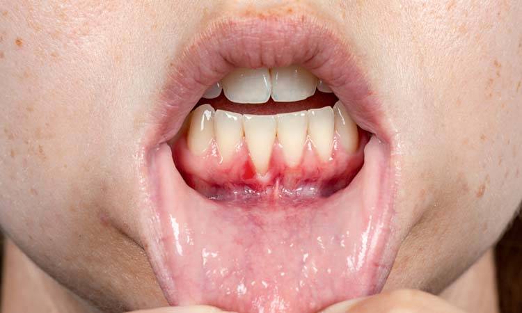 Oral Bacteria Are A Major Cause Of Periodontitis, Study