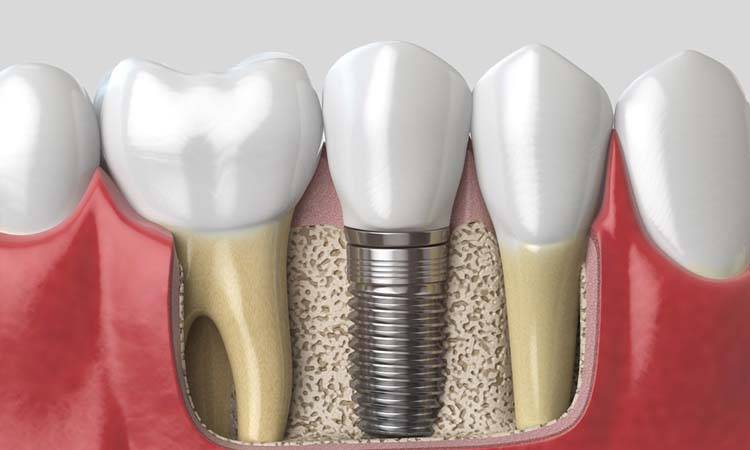 The Adsorption Of Oral Proteins On Implant's Chemically Modified Surface, Study