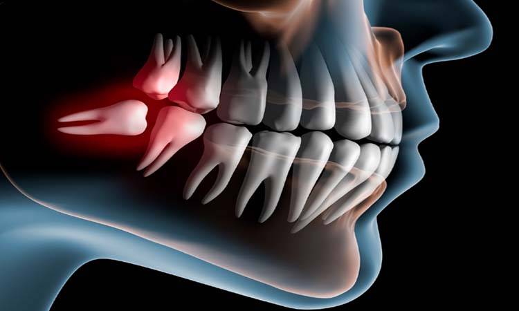 Wisdom Tooth Extraction: All You Should Know