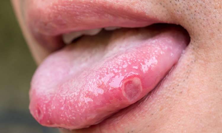 Tongue Blisters: Do you need to worry?