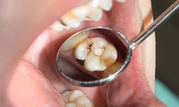 Sixty per cent of Pakistanis have dental caries: New Research