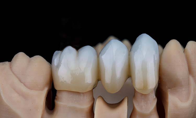 Dental Restorations: How To Make The Efficient Filling?