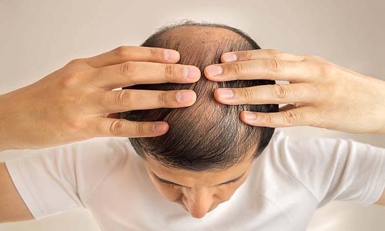 Obesity Leads To Hair Loss And Thinning, Study  