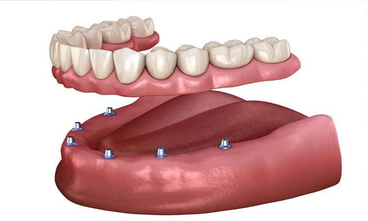 Ever-Changing World Of Dental Prosthetics