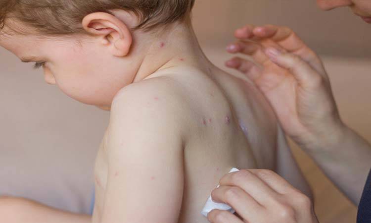 Measles-Rubella vaccination campaign to start next month