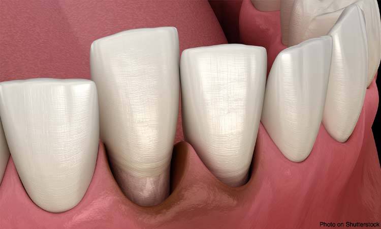 Obesity increases risk of tooth loss, gum disease - New study