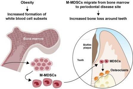 Obesity increases risk of tooth loss, gum disease - New study