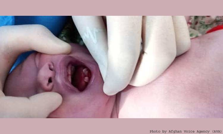 Baby borns with four natal teeth