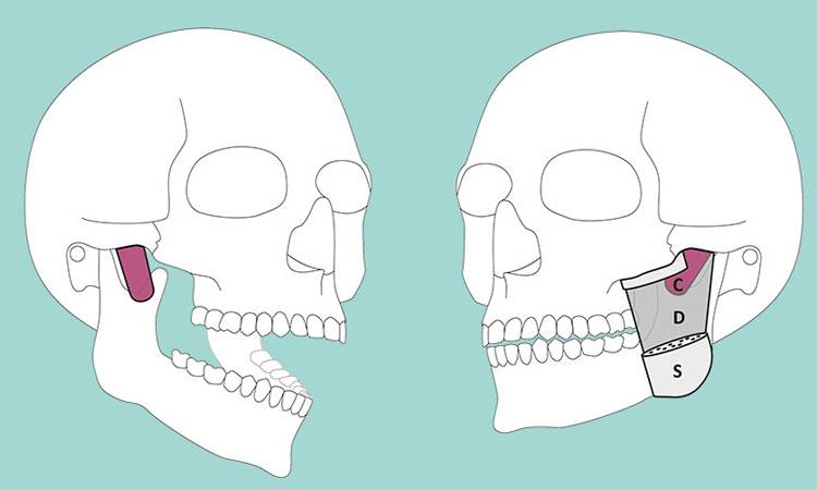 Scientists uncover new muscle layer on the human jaw