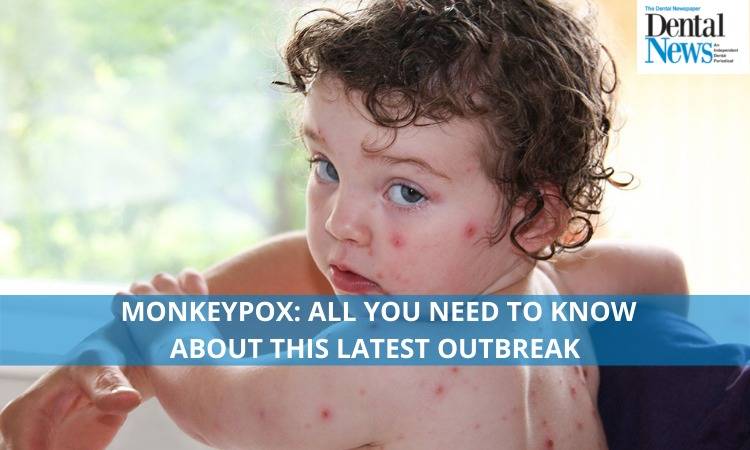 Monkeypox: All You Need to Know About This Latest Outbreak