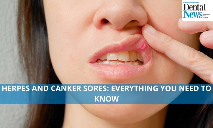 Herpes and Cold sores: Everything You Need To Know