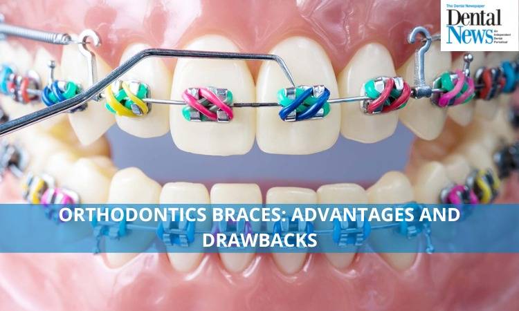   Orthodontic Braces: Advantages and drawbacks