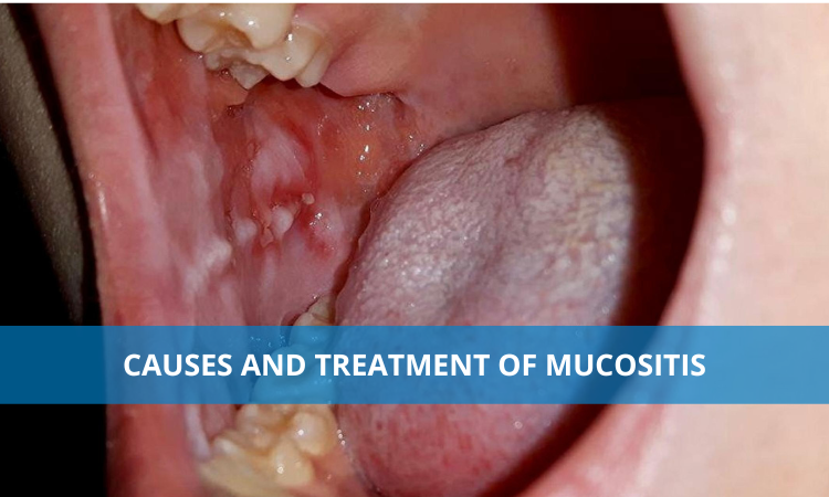 Causes and Treatment of Mucositis