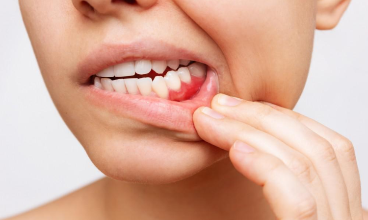 New gel can treat gum inflammation: Research