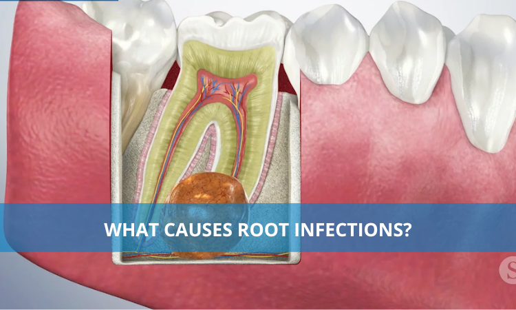 What Causes Root Infections?