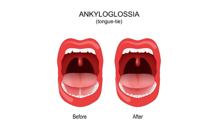 Ankyloglossia in children: the effects of various surgical procedures