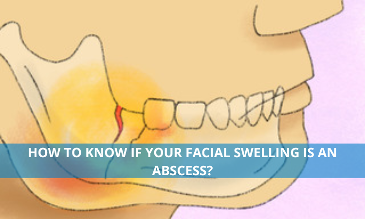 How to Know if Your Facial Swelling is an Abscess?