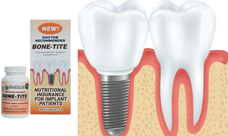 Dental implant patients can now use implant supplements post surgically