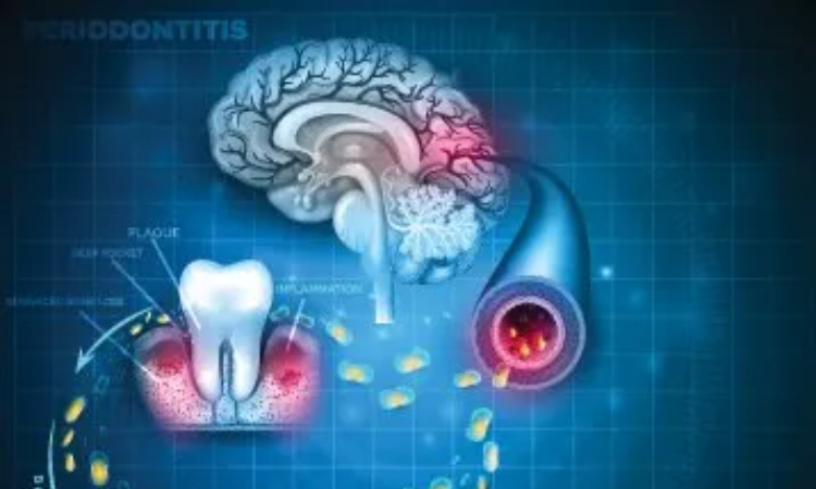 NYU Dentistry receives $3.1m grant to research on Alzheimer's and Periodontitis