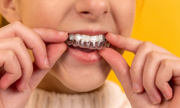 Dentists say online ordered clear braces can cause 'wobbly' teeth or tooth loss