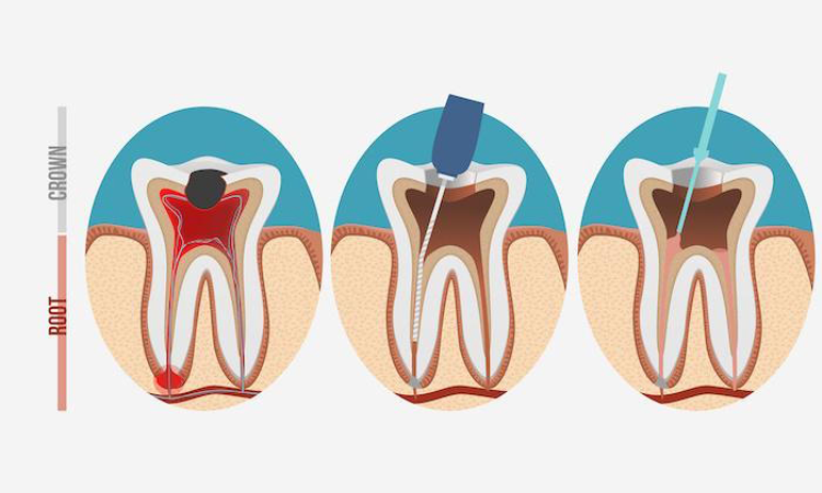 UB receives grant to improve vital pulp therapy, a root canal treatment alternative