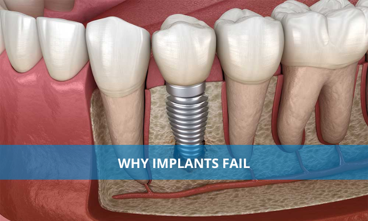 Why Implants Fail