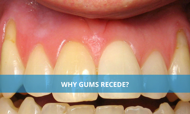 Why Gums Recede?