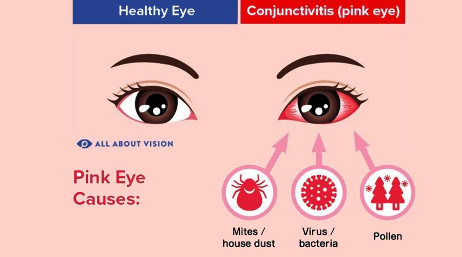 Pink Eye outbreak: Over 10,000 new cases emerge in Punjab in 24 hours