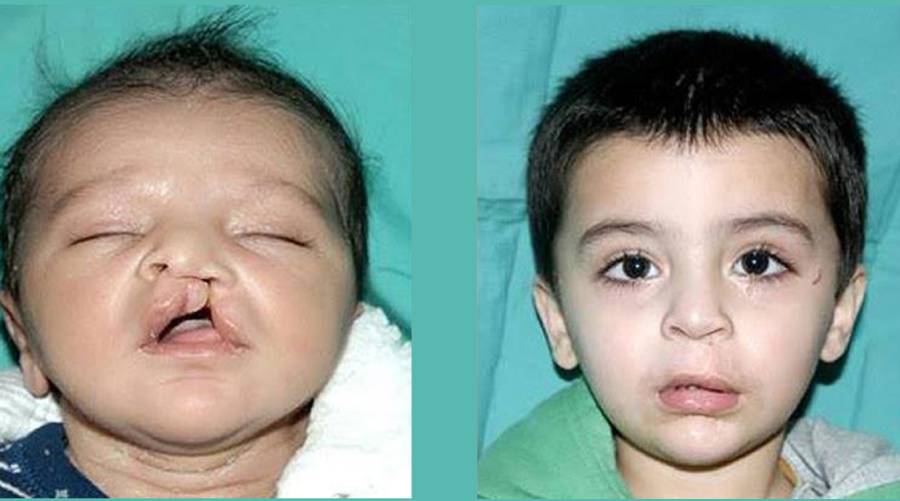 ICLAPA vows to continue free cleft lip and palate treatment