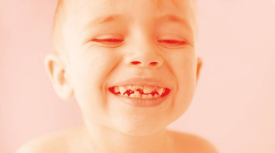 New strategies unveiled to combat tooth decay in young children