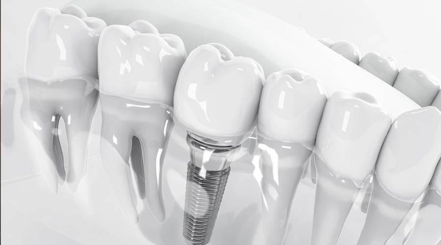 Your next dental implant could be made of fabric