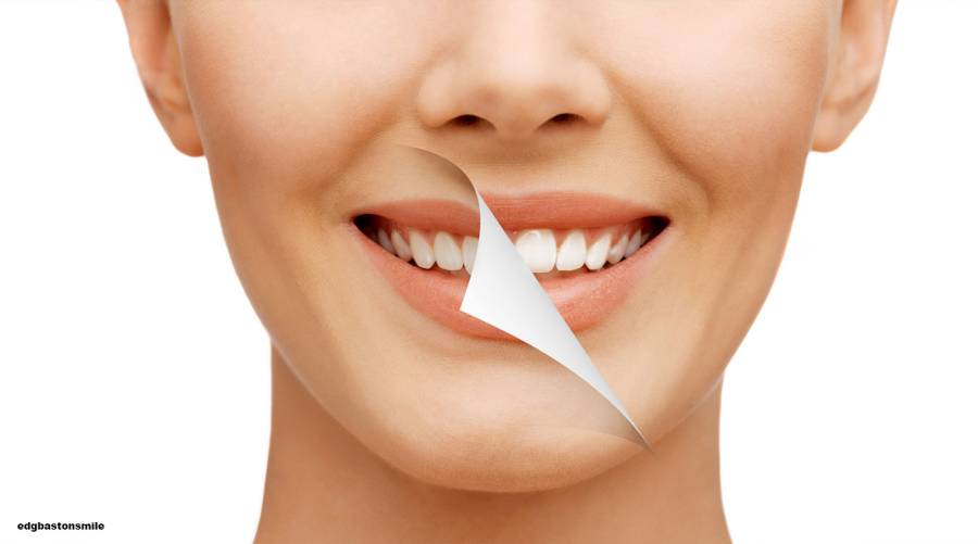 Tooth whitening: safe practice or risky procedure?