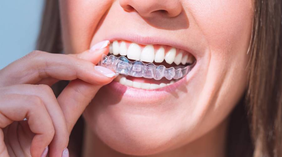 10 key insights into how invisible Aligners transform orthodontic care