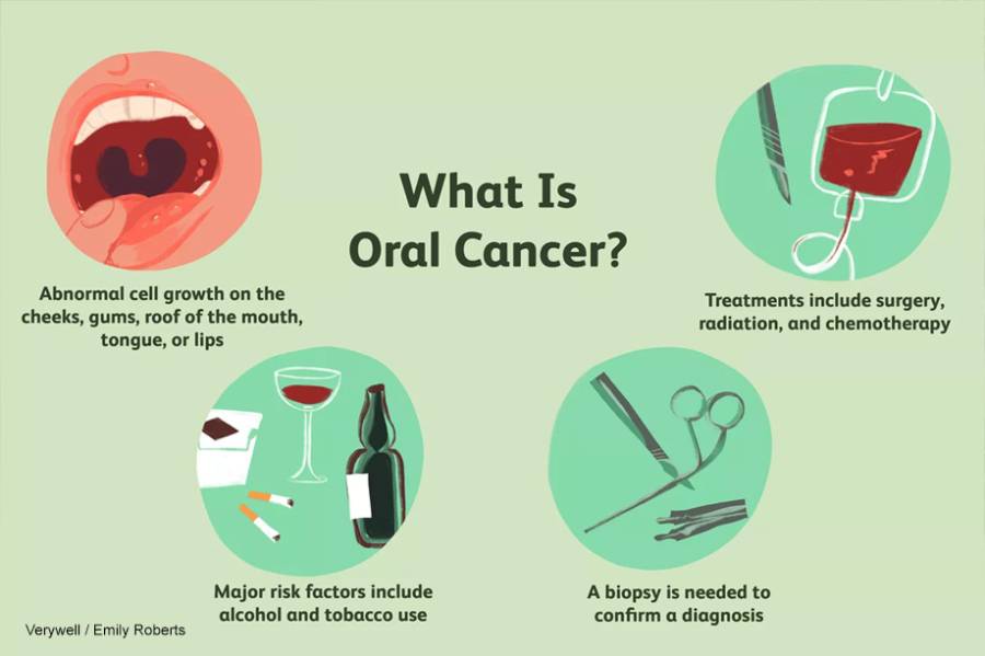 What Is Oral Cancer? Symptoms, causes, and essential prevention tips