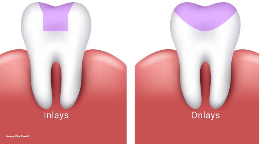 Dental Inlays and Onlays: The perfect solution for damaged teeth?