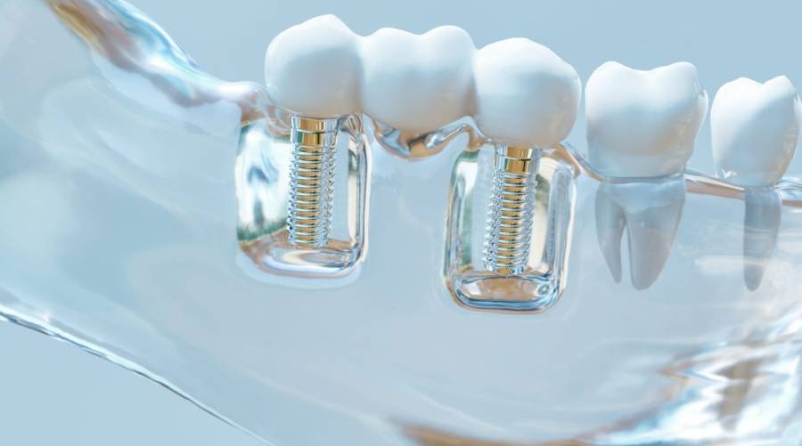 Close-up 3D rendering of dental implants embedded in a transparent jaw model, highlighting the integration of artificial teeth with the bone.